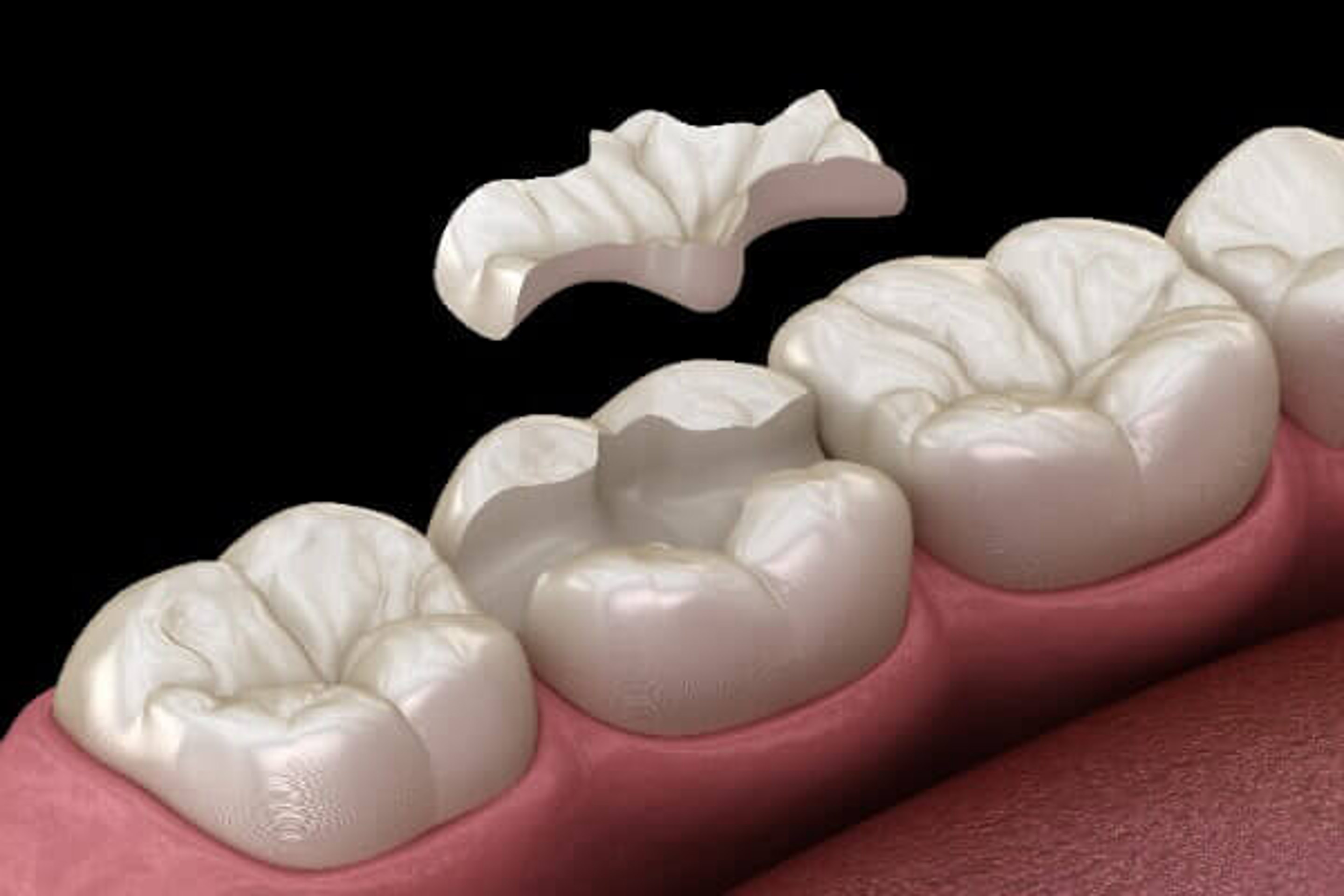 CEREC-Inlay – schematische Darstellung