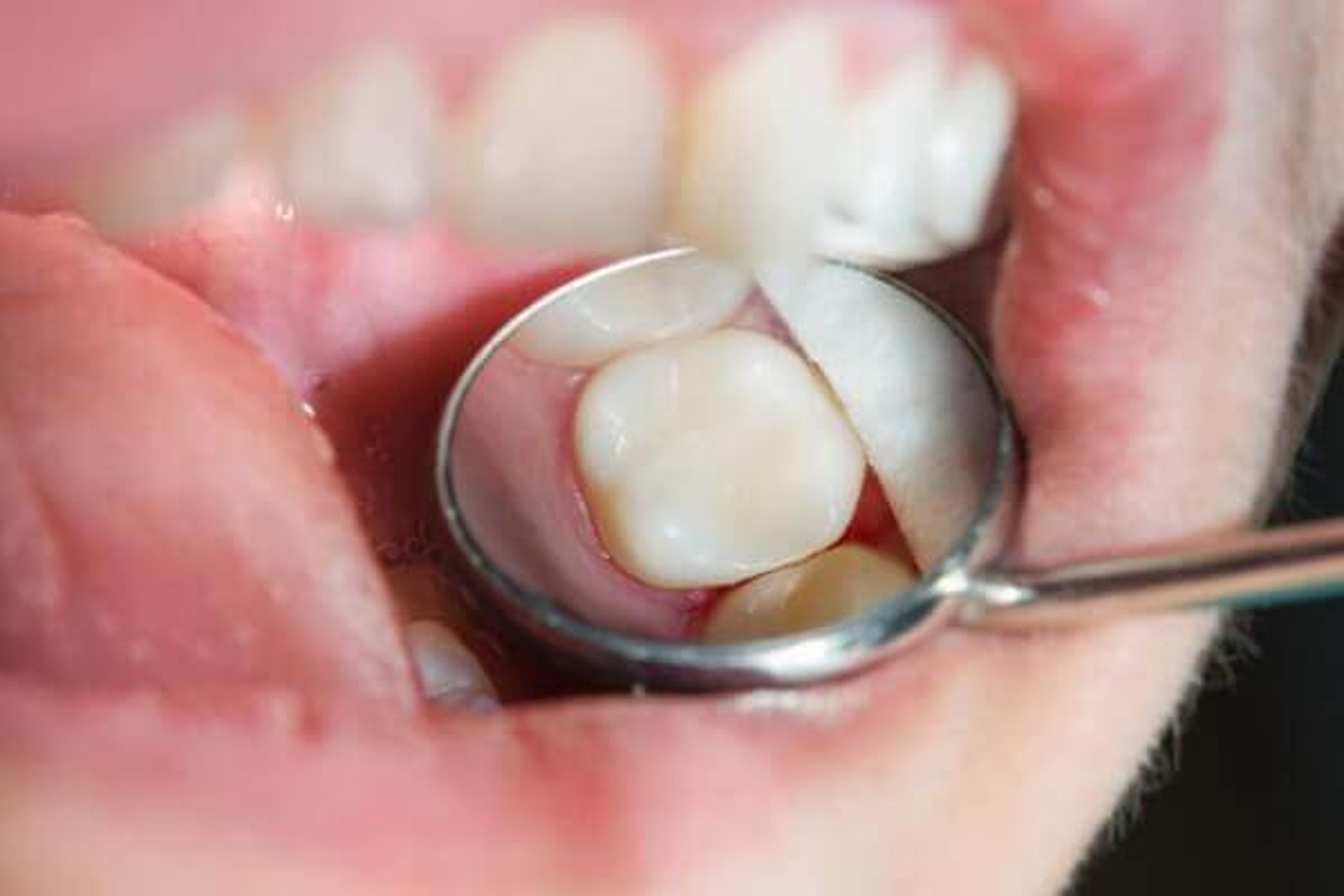 Eingesetzte CEREC-Krone im Spiegel