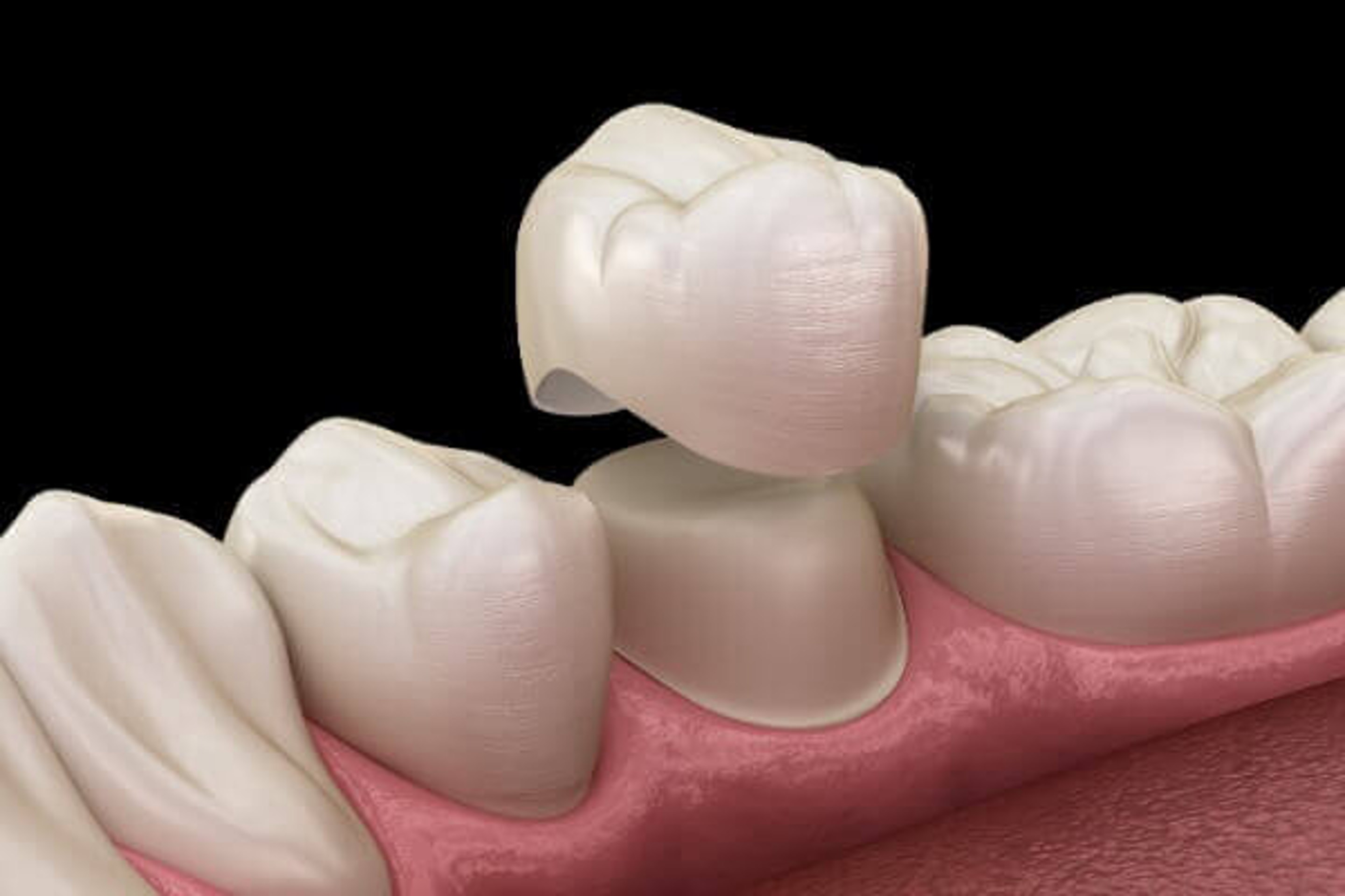 CEREC-Krone – schematische Darstellung