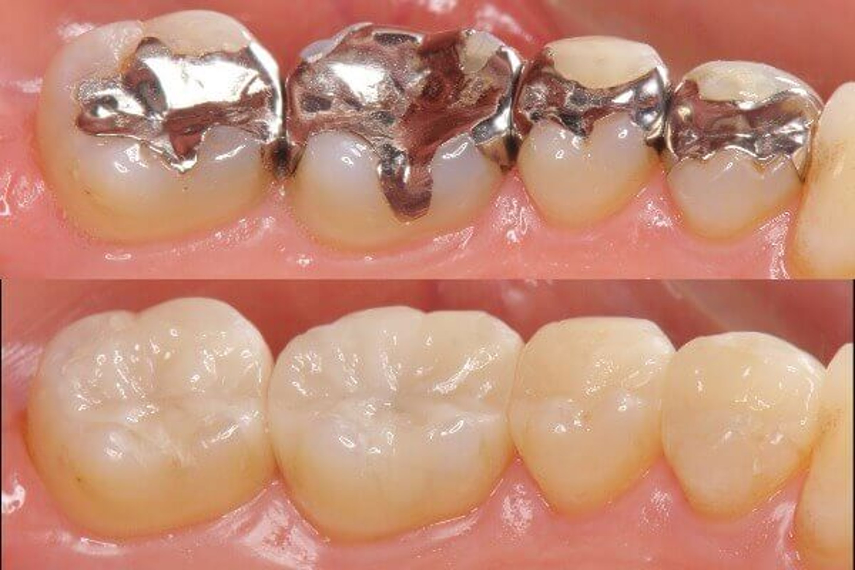 Vorher-Nachher: Amalgamfüllungen und CEREC-Inlays